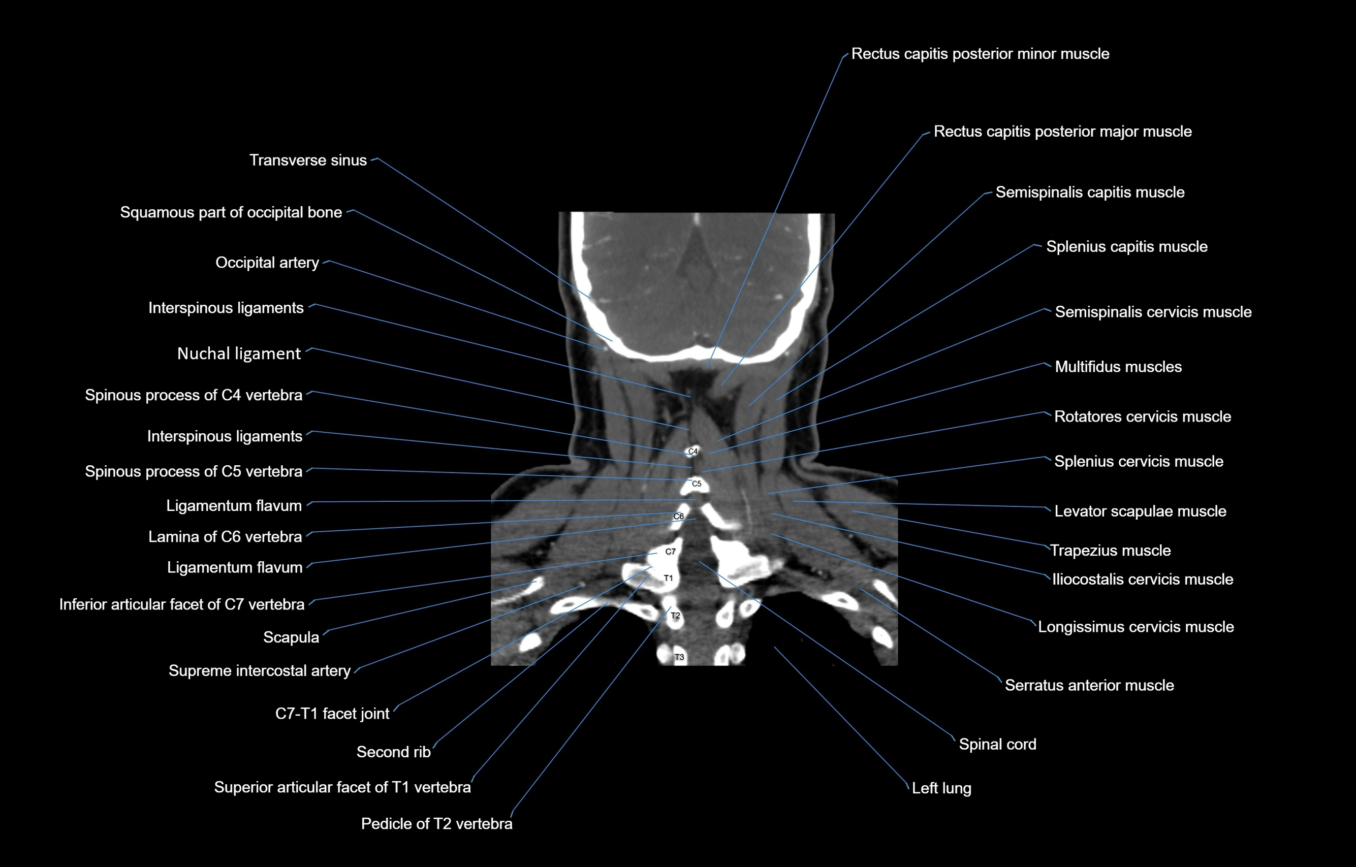 CT Neck coronal  cross sectional anatomy labelled 3D  radiology  image-00052.webp